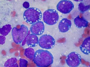 Burkitt lymphoma